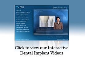 Dental Implants Presentation
